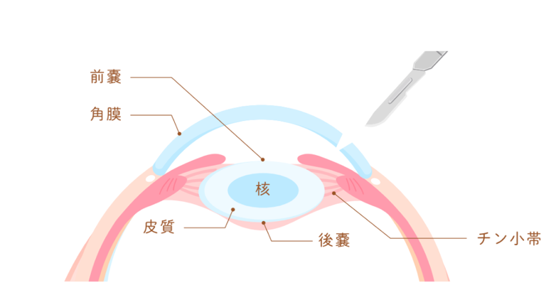 手術の方法1