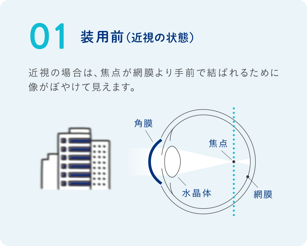 装用前（近視の状態）